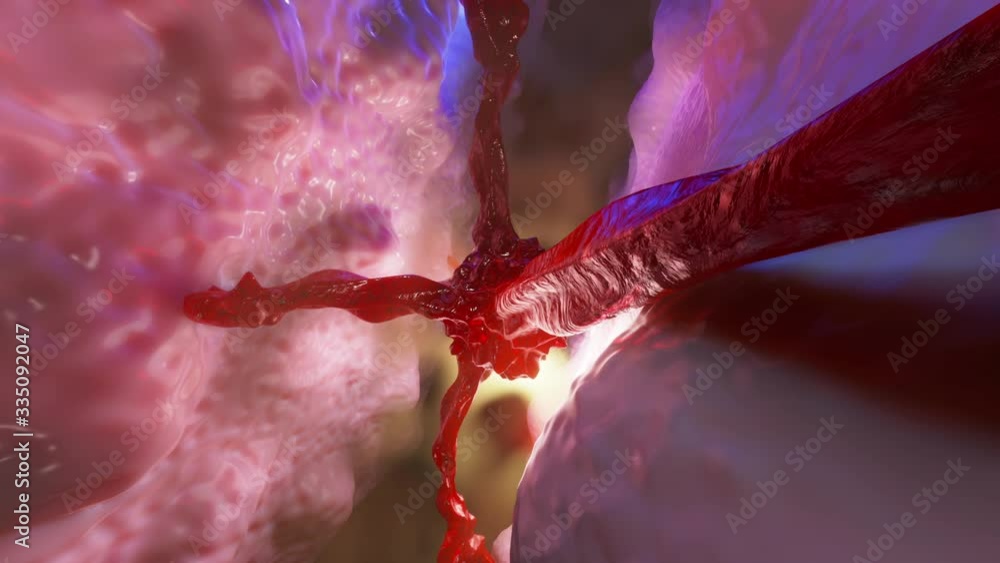 3D Animation of a growing Cancer Tumor or Metastasis spreading on ...