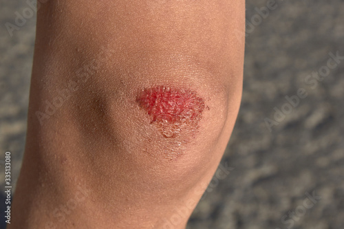 Wallpaper Mural bruised wound on the knee, the boy fell and scratched his knee Torontodigital.ca