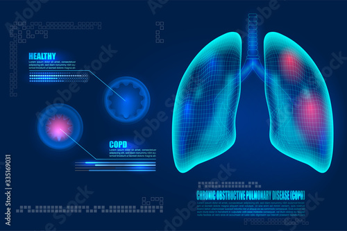 Healthcare futuristic technology Human lungs with COPD chronic obstructive pulmonary disease. Lungs inflammation symptoms causes diagram. Compared healthy airways and emphysema or bronchitis sickness