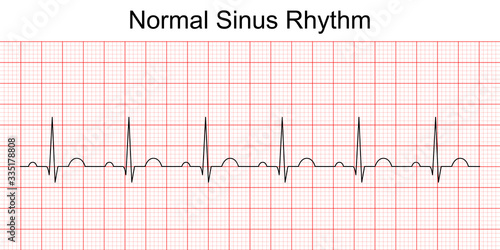 Electrocardiogram show normal heart beat line (Sinus rhythm). ECG. EKG. Vital sign. Medical healthcare symbol.