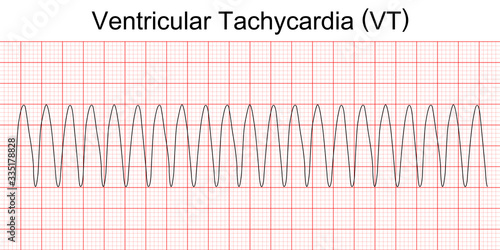 Fotografia Electrocardiogram show monomorphic ventricular tachycardia (VT)