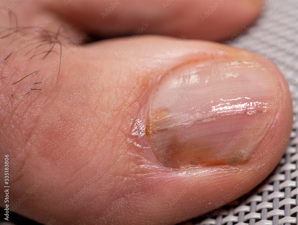 Fototapeta premium Nail infections caused by fungi such as: onychomycosis caused by dermatophytes and yeasts and for the concomitant antibacterial activity