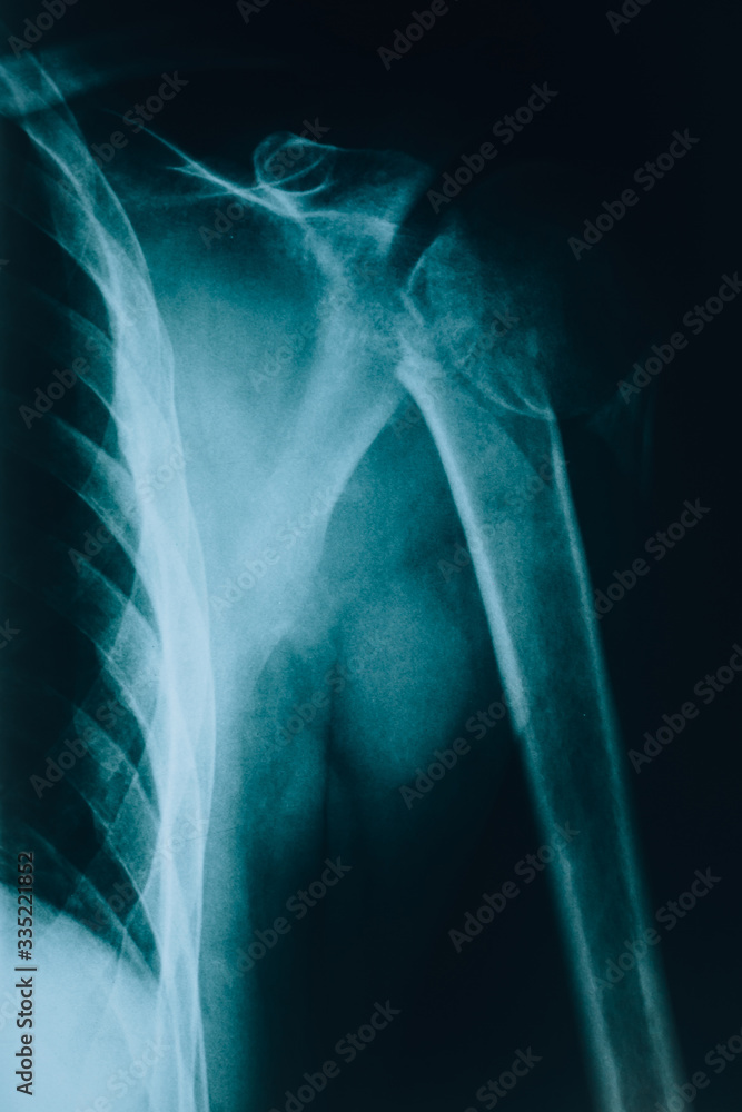 X-ray of the shoulder. Human bones. Examined by a radiologist