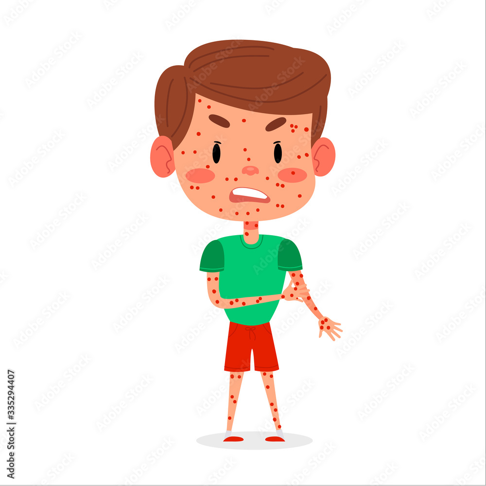 Kid boy has chickenpox or measles disease. Red rash on children body vector illustration Kid boy has chickenpox or measles disease. Red rash on children body vector illustration