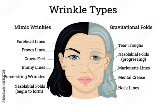 Wrinkle Types Illustration