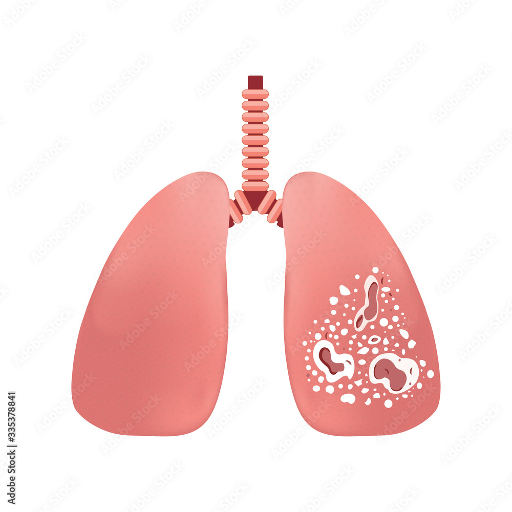 Healthy lung and lung infected with tuberculosis. Virus or bacterial infects lungs,Coronavirus causing pneumonia of the lungs. Virus causing pneumonia. 2019-nCov coronavirus epidemic. Healthy lung and lung infected with tuberculosis. Virus or bacterial infects lungs,Coronavirus causing pneumonia of the lungs. Virus causing pneumonia. 2019-nCov coronavirus epidemic.