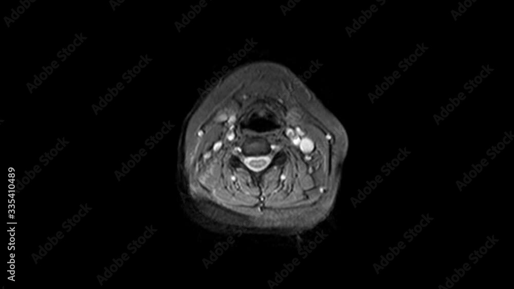 Postoperative MRI of female organs for the detection of metastases. Postoperative MRI of female organs for the detection of metastases.