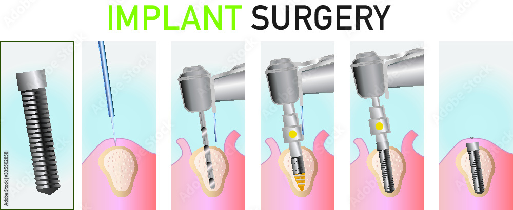 Obraz premium Implant surgery