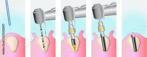 Implant surgery