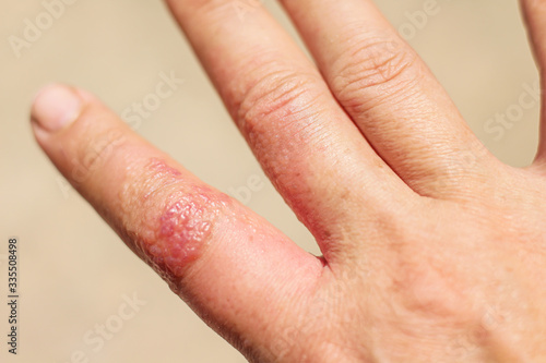 Allergy symptom many red rash and blister on finger right hand woman after used alcohol gel during the corona virus outbreak