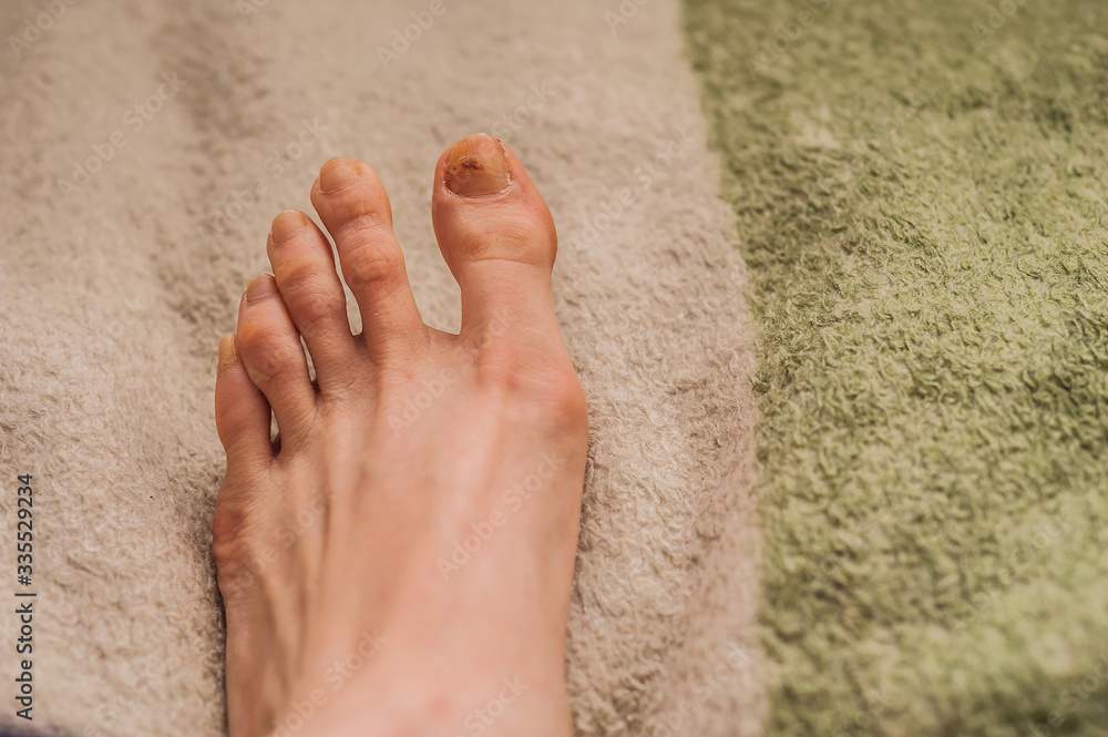 injury of the toenail effects,fungus on the toe nail,fungus on the toe
