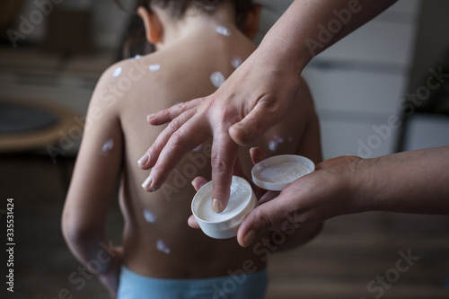 Obraz na plátně Mother applies daughter cream on chickenpox.