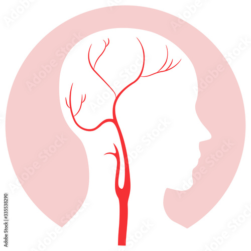 Silhouette Carotid Artery I...