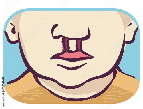 Symptom Cleft Lip Palate Bilateral Illustration