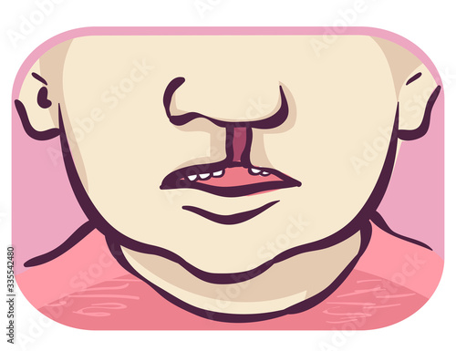 Symptom Cleft Palate Unilateral Illustration