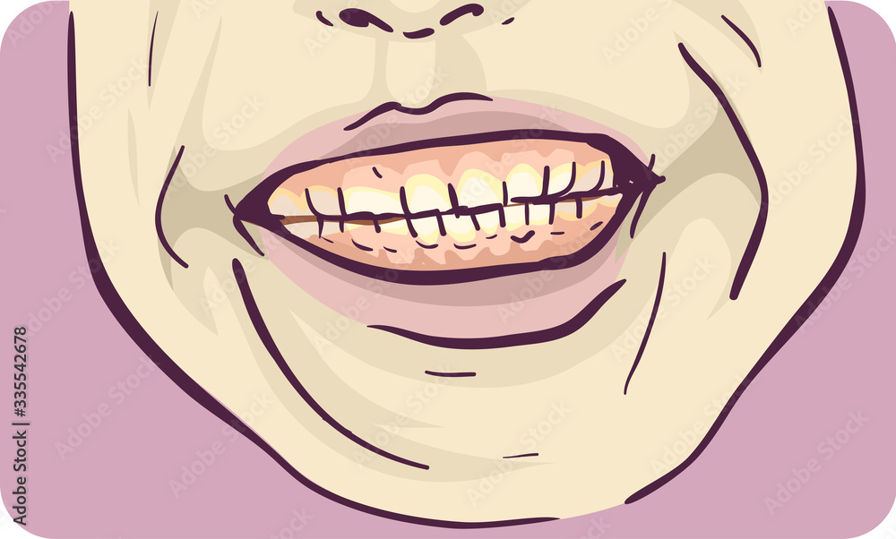Naklejka premium Symptom Teeth Grinding Illustration