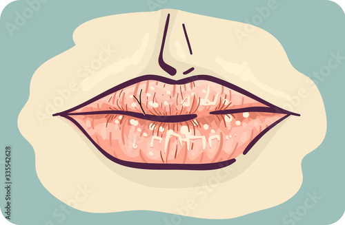 Symptom Dry Chapped Lips Illustration