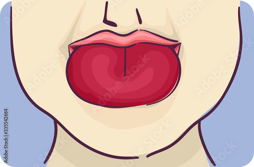 Symptom Swelling Tongue Illustration