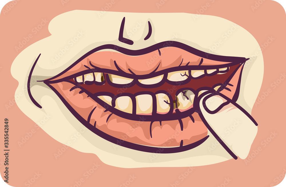 Symptoms Tooth Decay Illustration Symptoms Tooth Decay Illustration