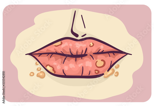 Symptoms Lip Cold Sore Illustration