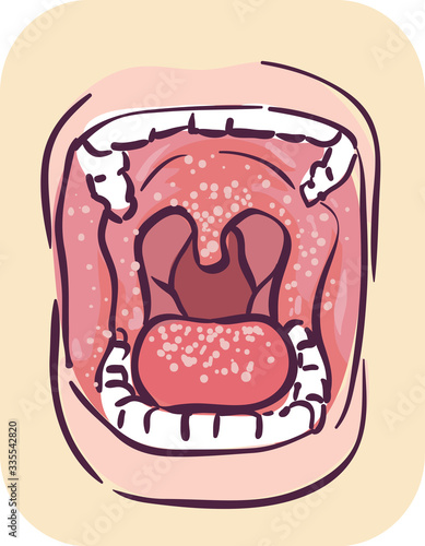 Symptoms Oral Thrush Illustration