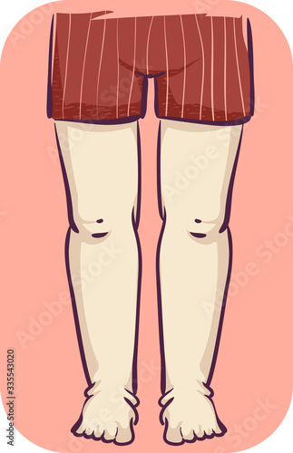 Girl Leg Swelling Illustration
