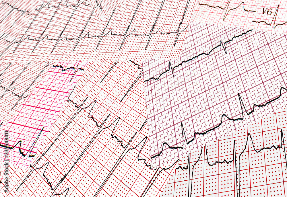 Many results of cardiogram are sparse chaotically. Abstract background Many results of cardiogram are sparse chaotically. Abstract background