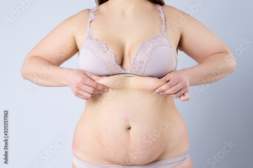 Tummy tuck, flabby skin on a fat belly, plastic surgery concept