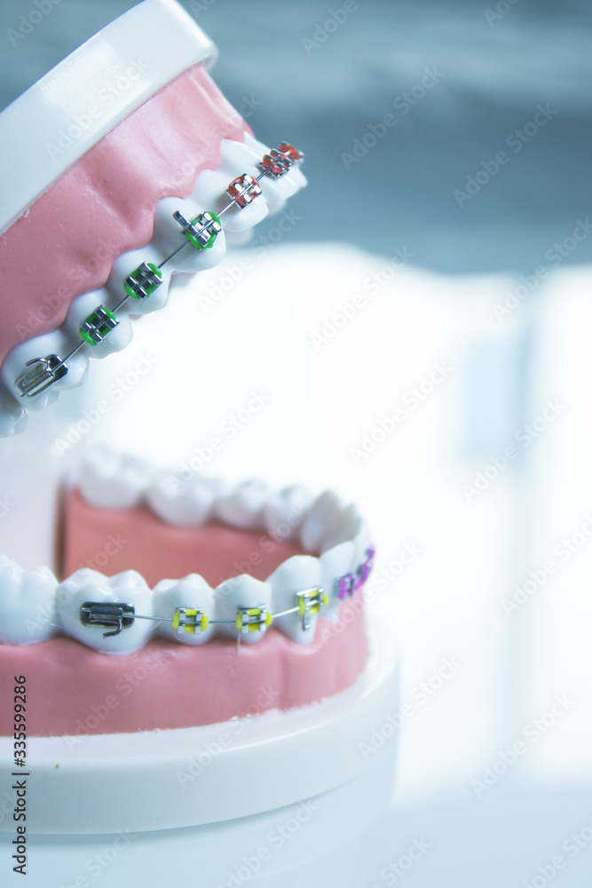 Model denture with metal orthodontics Model denture with metal orthodontics