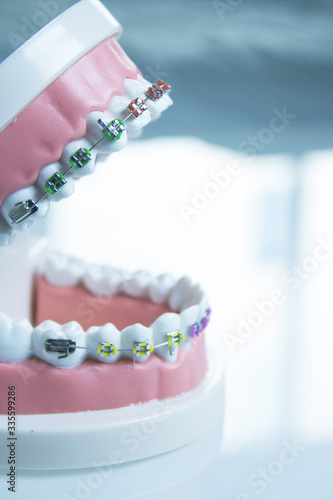 Model denture with metal orthodontics
