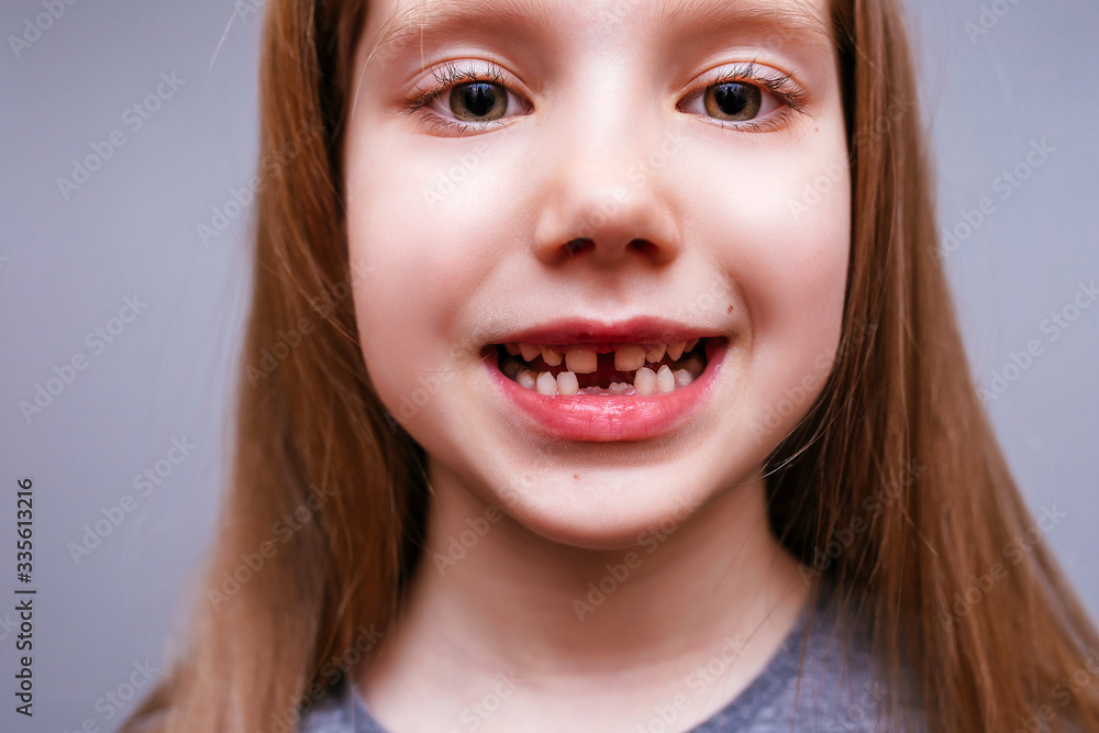 Close-up face of a girl whose lower milk teeth fell out Close-up face of a girl whose lower milk teeth fell out