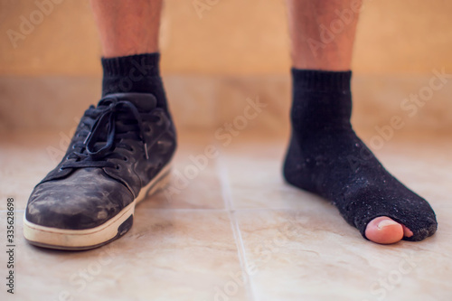 Man wearing holey sock and dirty shoes. Poorness and untidiness concept