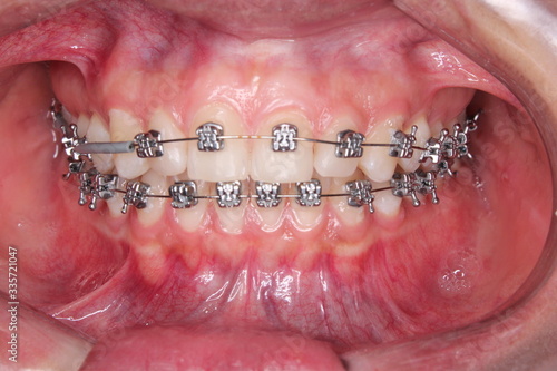 Frontal Oclussion