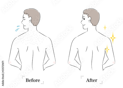 背中 肌 悩み ムダ毛 産毛 ビフォーアフター 男性 Stock Vector Adobe Stock 背中 肌 悩み ムダ毛 産毛 ビフォーアフター 男性 Stock Vector Adobe Stock