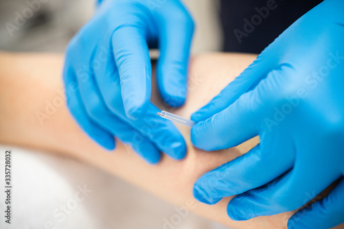 Vászonkép Hands of physiotherapist doing a dry needling
