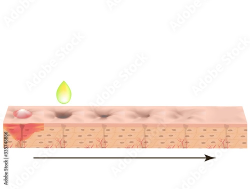 Atrophic scars. Acne scar. The anatomical structure of the skin with acne. Vector illustration on isolated background.