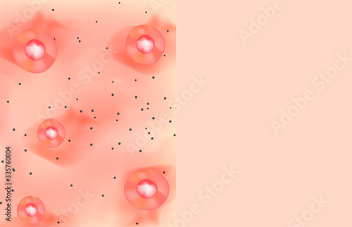 Texture, inflamed pimples and acne. Before After acne cysts. Skin background. Infographics. Vector illustration on isolated background.