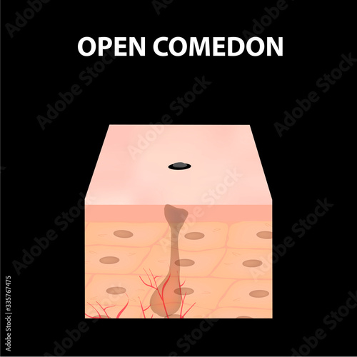 Open comedones. Acne on the skin. Dermatological and cosmetic diseases on the skin of the face acne. Infographics. Vector illustration on isolated background.