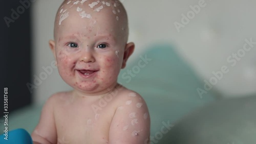 chicken pox varicella disease of child face portrait .