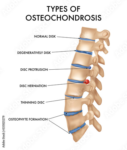 Spine Hernia Realistic Chart 