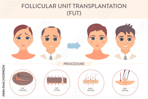 Hair transplant alopecia treatment by FUT. Stages of follicular unit transplantation restoration surgery for men and women. Health care and medical concept. Vector illustration.