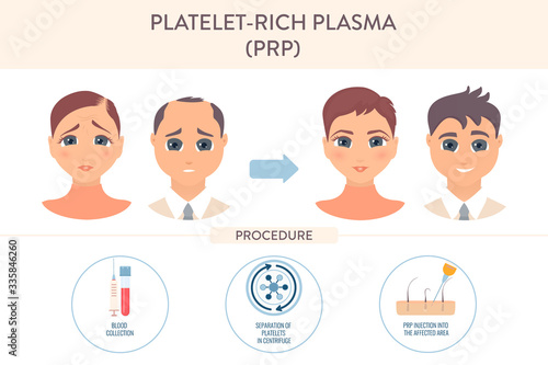 Hair loss treatment by PRP therapy. Stages of platelet-rich plasma restoration procedure for men and women. Health care and medical concept. Vector illustration.