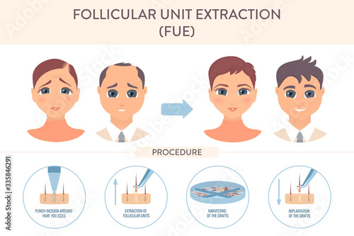 Hair transplant alopecia treatment by FUE. Stages of follicular unit extraction restoration surgery for women and men. Health care and medical concept. Vector illustration.