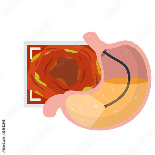 Gastroscopy. Endoscopy and digestive problems. Hose with camera. Procedure with internal organs. Cartoon flat illustration. Medical Visual inspection of stomach. Scan of monitor with screen