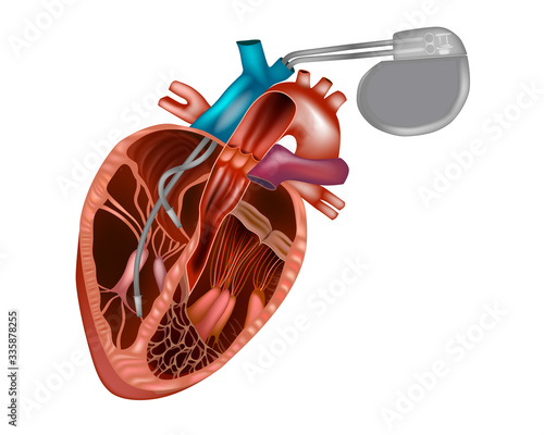 Cardiac pacemaker or artificial pacemaker. Heart pacemaker