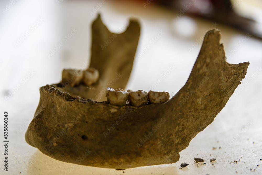 Jaw bonewith five molars remaining in-situ, after being dug up.