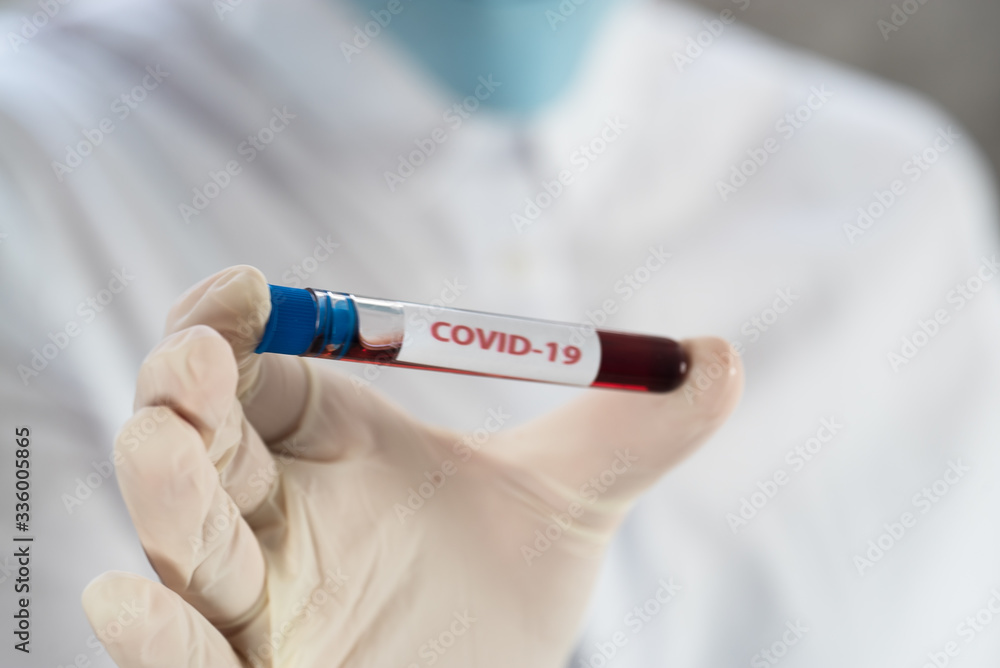 Positive COVID-19, SARS-COv2 test and laboratory sample of blood testing for diagnosis new Coronavirus infection.. Positive COVID-19, SARS-COv2 test and laboratory sample of blood testing for diagnosis new Coronavirus infection..