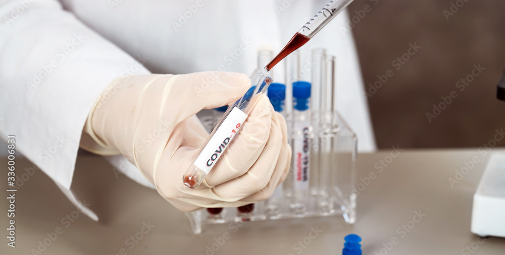 Positive COVID-19, SARS-COv2 test and laboratory sample of blood testing for diagnosis new Coronavirus infection.. Positive COVID-19, SARS-COv2 test and laboratory sample of blood testing for diagnosis new Coronavirus infection..