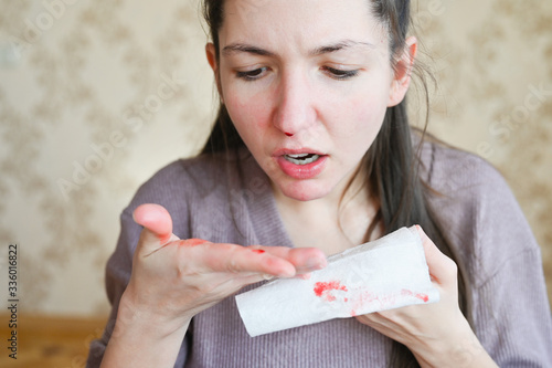 Nosebleed, a young woman with a bloody nose. Healthcare and medical concept. Close-up