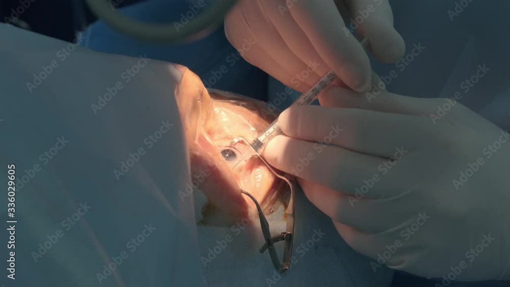Anesthesia before ophthalmology operation, Surgeon's hands in gloves